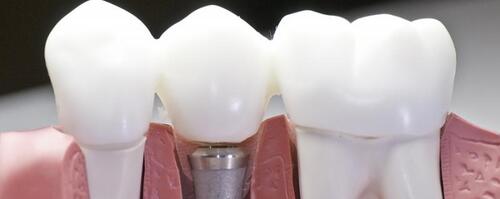 Имплантация зубов 3