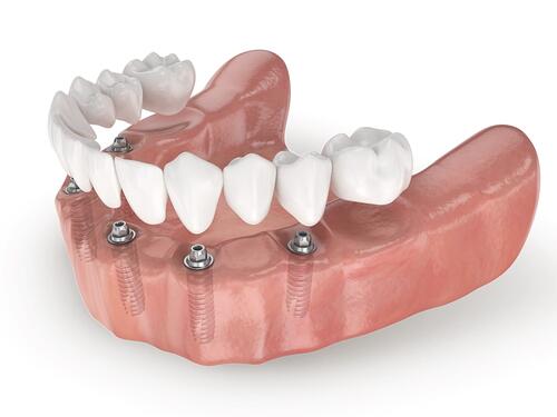 имплантация зубов по методу "всё на 4"