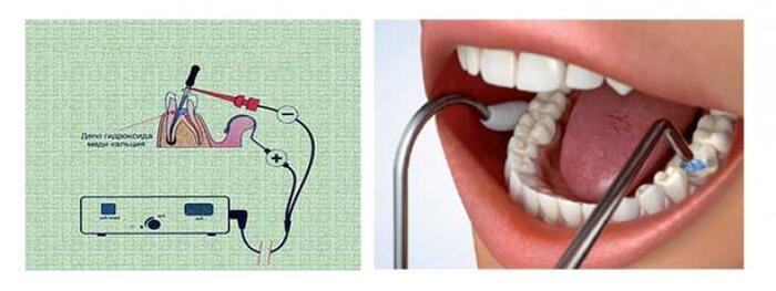 Процедура депофореза в стоматологии