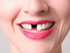 Отсутствие переднего зуба