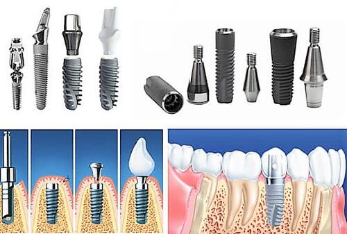 Стоматология "Костамед" устанваливает зубные импланты ведущих производителей мира.