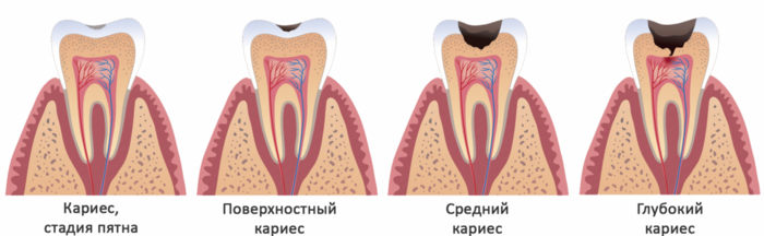 Этапы лечения кариеса зубов