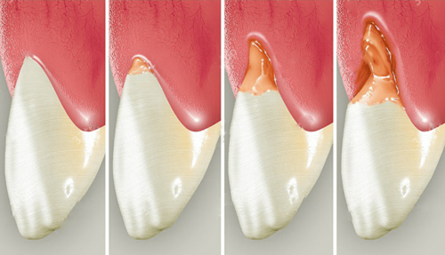 Некариозное поражение пришеечной зоны зуба