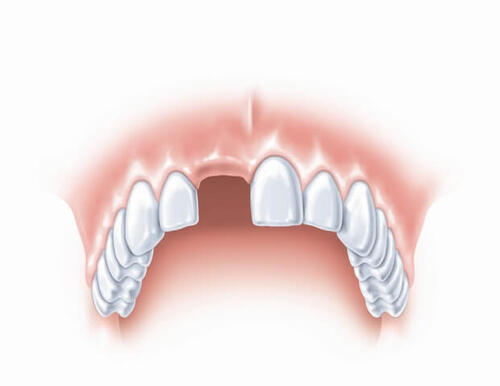 Отсутствие зубов