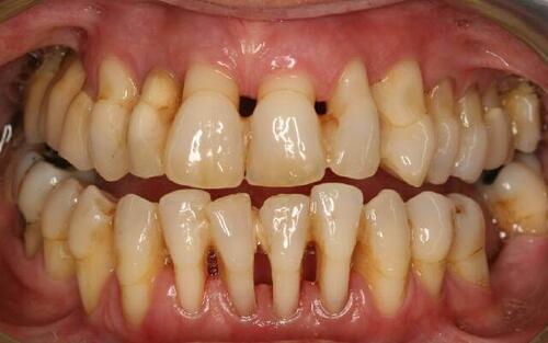 Запущенная форма пародонтоза. На фото также видно большое количество зубного камня, способствовавшего развитию пародонтоза.