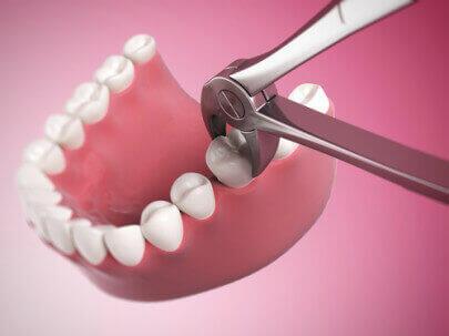 Удаление зуба-это тоже операция