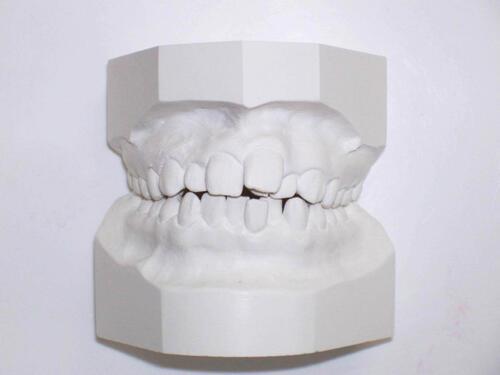 Слепки челюстей у ортодонта
